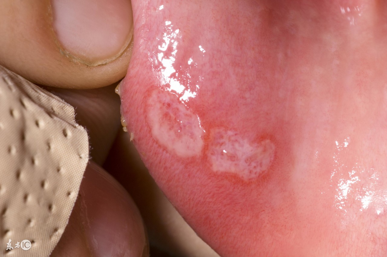 鹅口疮引起败血症,鹅口疮会诱发败血症吗