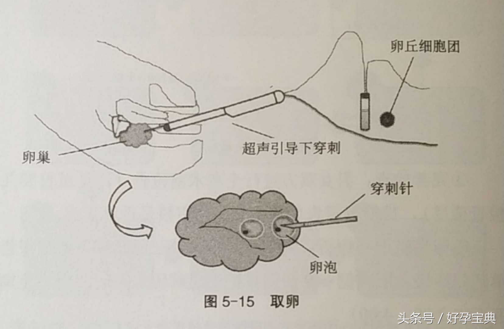 试管婴儿采用什么技术,了解试管婴儿治疗的整体流程