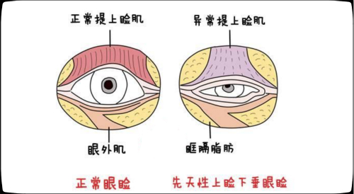 家长警惕：孩子一只眼大、一只眼小，可能是摊上了一种病