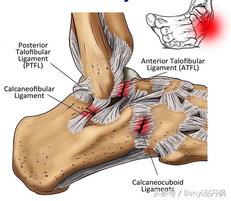 脚踝伤病的六个问题,脚踝受伤康复训练篮球