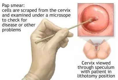 宫颈癌乳腺癌免费筛查怎么检查,妇科肿瘤科普小视频