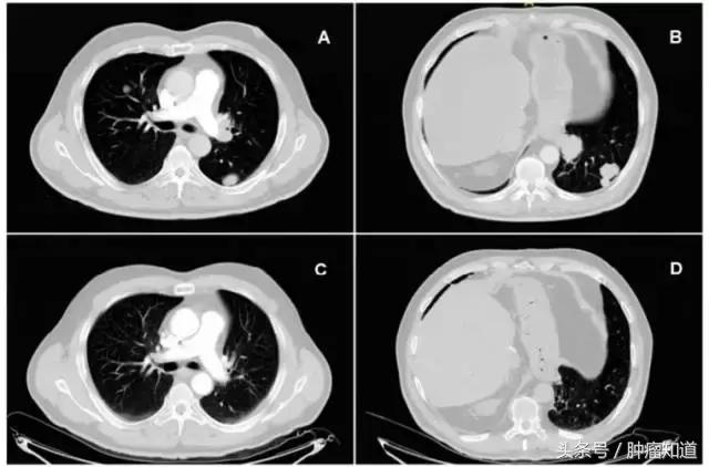 世界第一例cart治愈晚期肝癌,世界首例car-t疗法治愈肝癌案例
