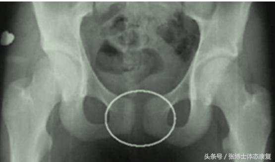 产后耻骨联合分离康复训练,耻骨肌运动康复方案