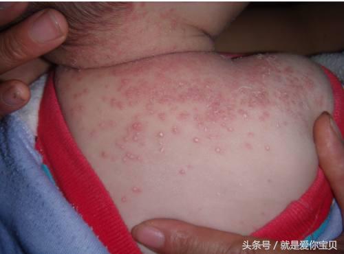 冬天儿童湿疹的最好解决方法,宝宝冬天湿疹高发怎么办