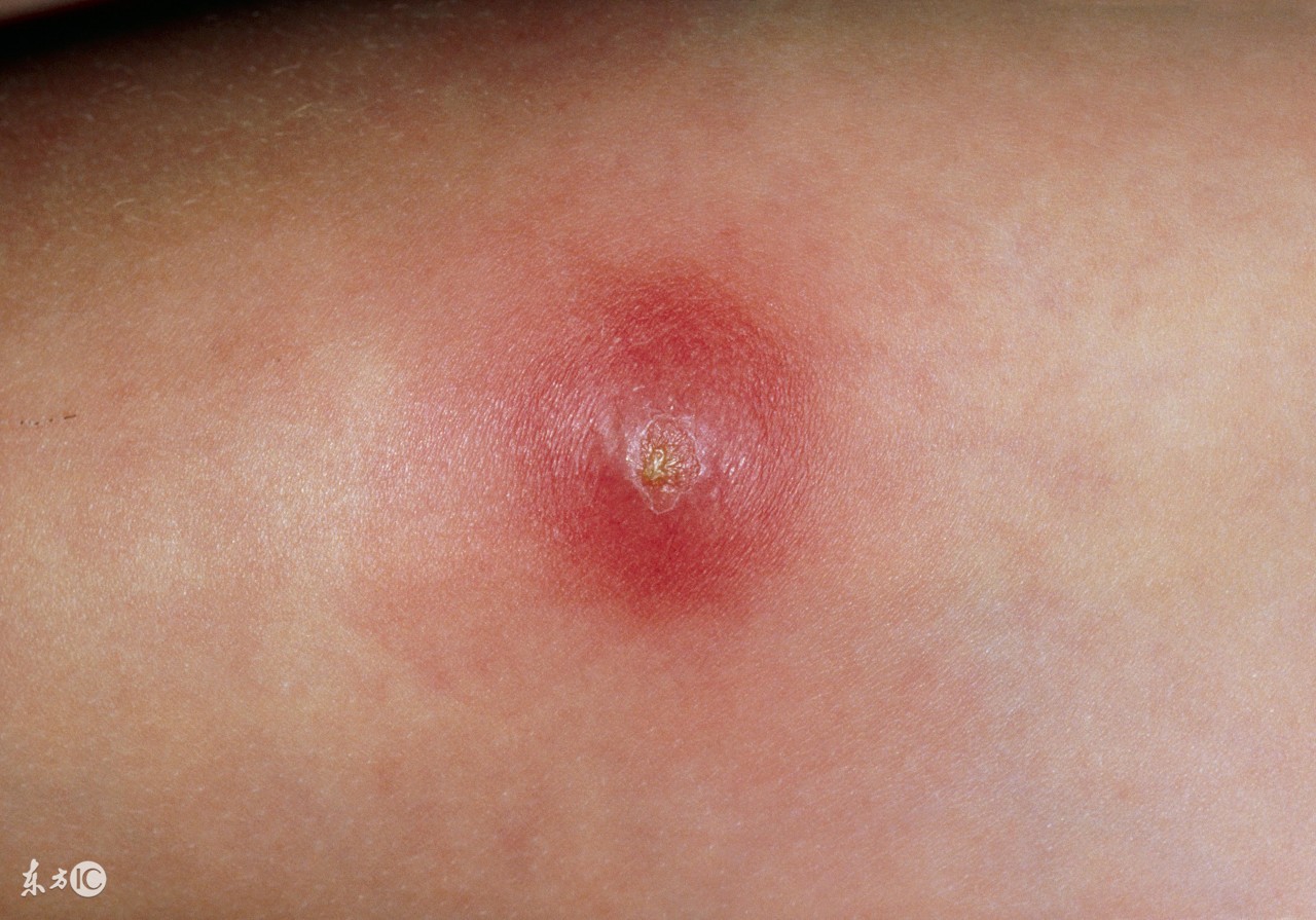 金银花泡水喝治皮肤痒吗,长疖子能喝金银花泡水吗