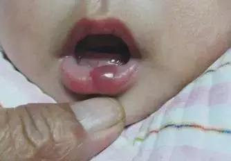 口水分泌多对身体有坏处嘛,口水多会加重会厌囊肿吗