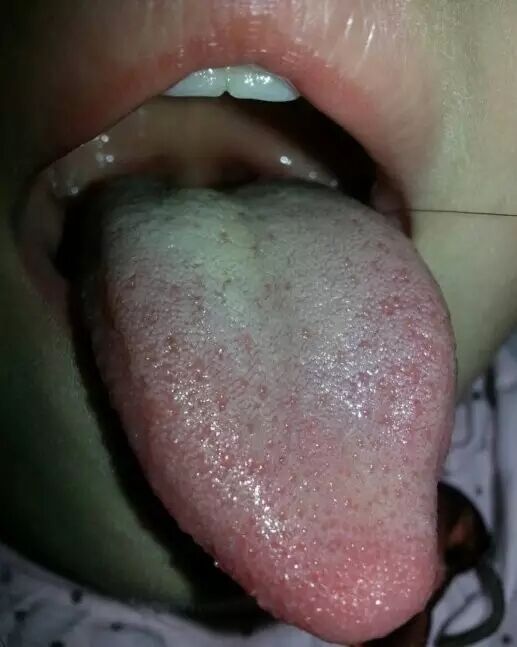 中医小儿舌诊辨证图谱,小儿舌诊辨证图谱课件