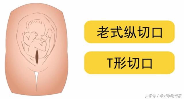 二剖三顺是真的吗,一剖二顺真的有用吗