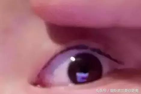 碧*诺斯**兰要你更美：用手抠掉痂皮，没色你怪谁？