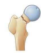 骨病分为骨质疏松和骨关节炎,骨质增生关节炎是什么症状