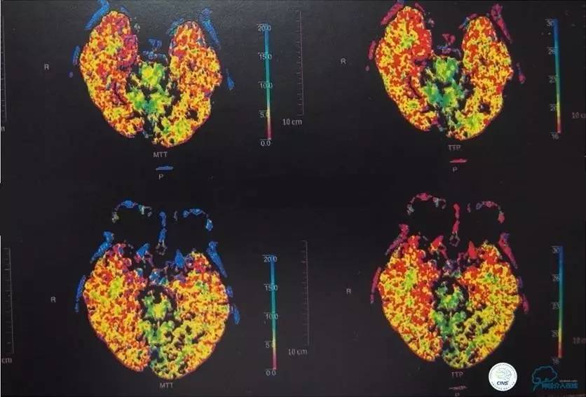 急性缺血性卒中静脉溶栓2018指南,急性缺血性卒中血管内再通标准