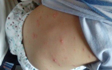 幼儿疹子的症状和治疗方法,幼儿各种疹子的症状及护理