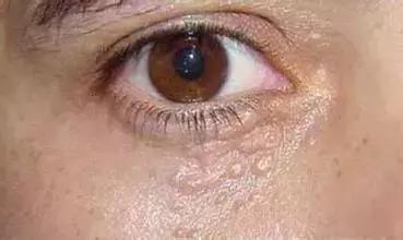 脸上小疙瘩消除最快方法,脸上小疙瘩密密麻麻怎么治疗