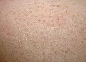 脸上小疙瘩消除最快方法,脸上小疙瘩密密麻麻怎么治疗