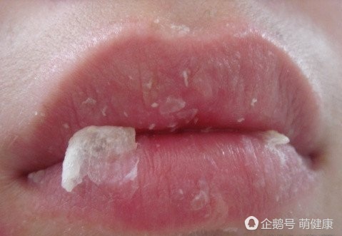 嘴唇干裂用什么小妙招,嘴唇干裂怎么办这些小妙招别错过
