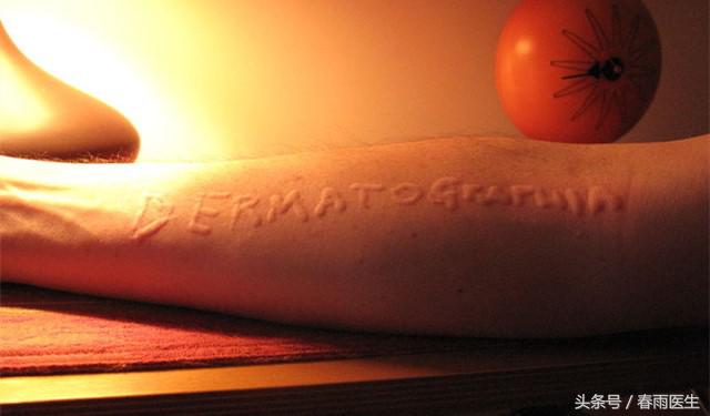 皮肤碰一下就有印子,皮肤轻轻一动就是红印子怎么回事