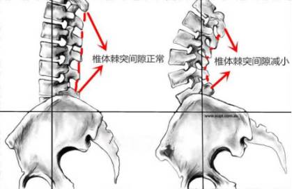 你的屁屁是真的蜜桃臀？还是骨盆前倾的伪翘臀？