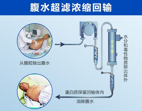 怎么才能把肝腹水弄出来,怀孕出现肝腹水是怎么回事