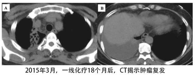 alk阳性肺癌克唑替尼,肺腺癌met基因突变克唑替尼耐药