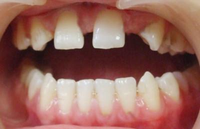 牙齿断裂有裂纹快要脱落怎么办,牙齿烂掉如何才能缓解牙痛