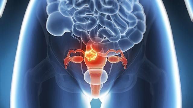 女孩因月经不调就诊，医生却让她切子宫？