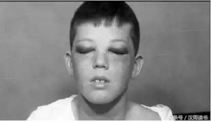 他用一根长钉从眼眶锤入那个人的头颅竟只为了治精神病