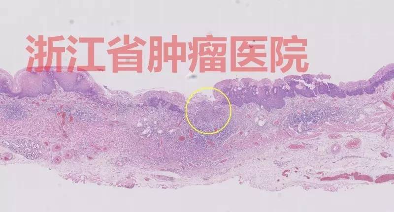 食管黏膜病变越大就一定是恶性吗,食管病变严重需要怎么治疗