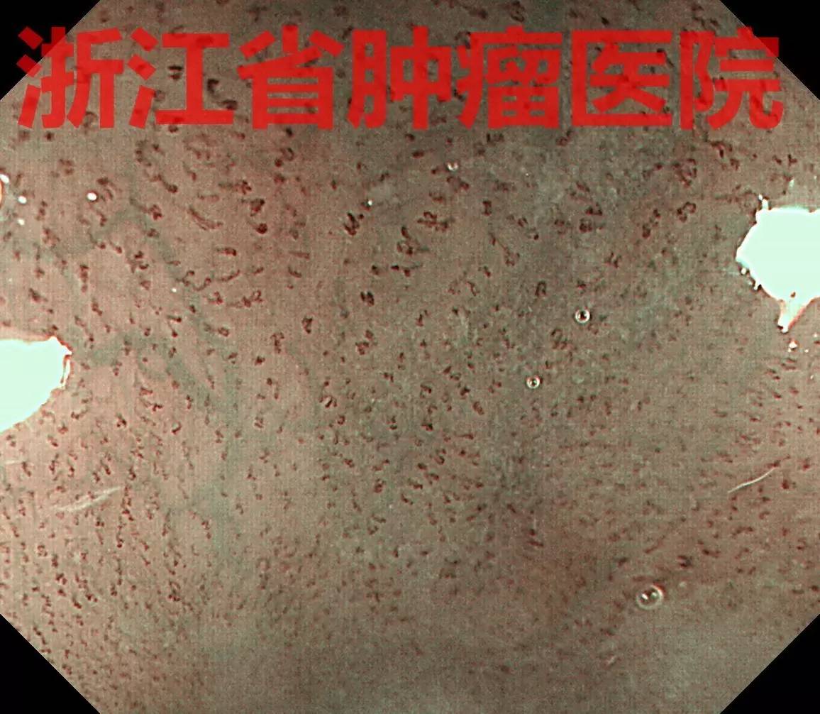 食管黏膜病变越大就一定是恶性吗,食管病变严重需要怎么治疗