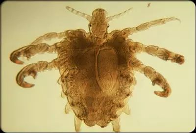 怎样判定身上痒是疥疮,怀疑是疥疮怎么治