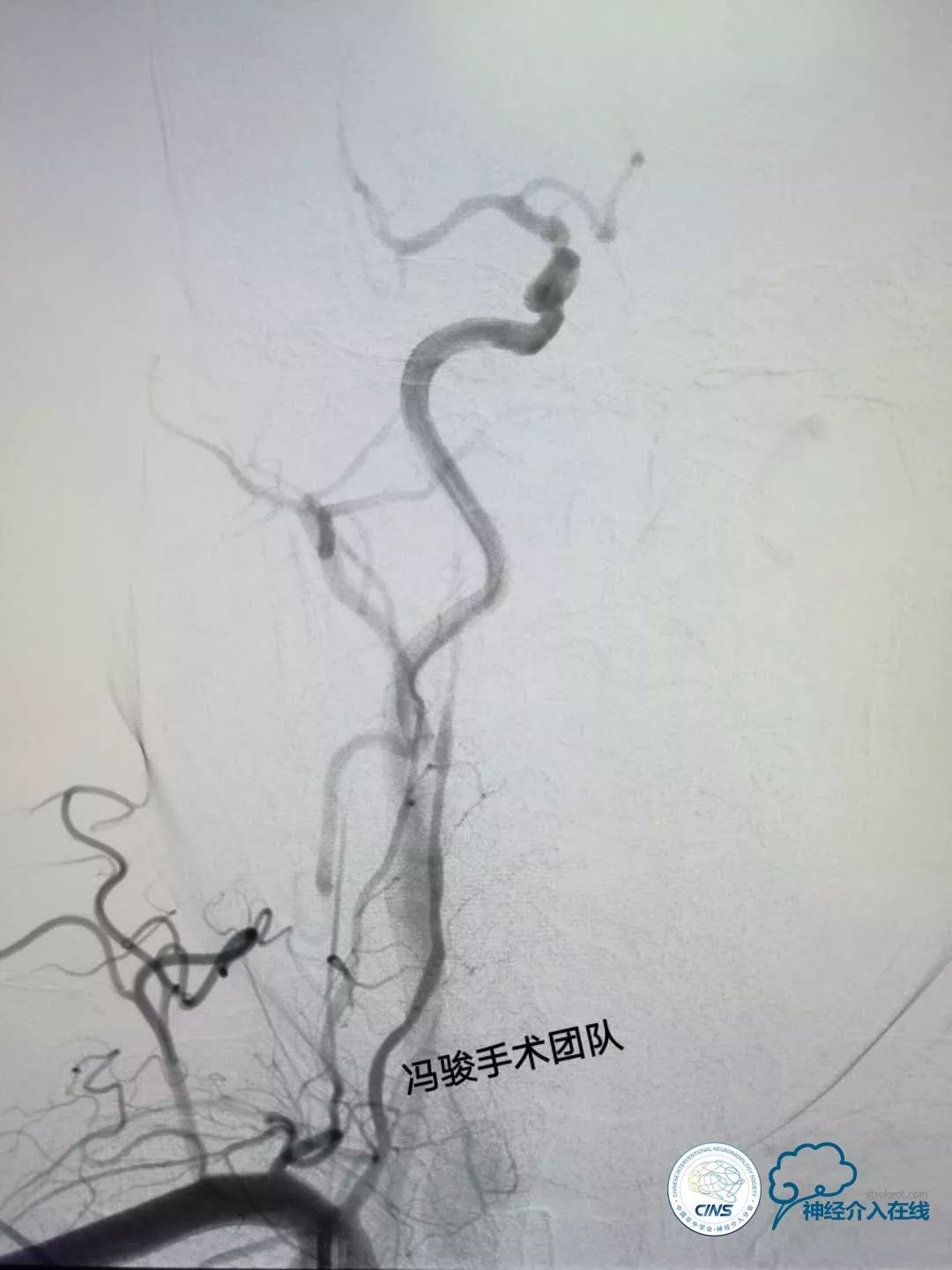 天新福—百家百言｜一例孤独椎动脉V4段并PICA重度狭窄支架手术及1年随访