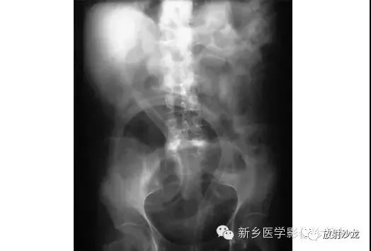 详细腹部平片解剖+正常表现+读片技巧+病例分析