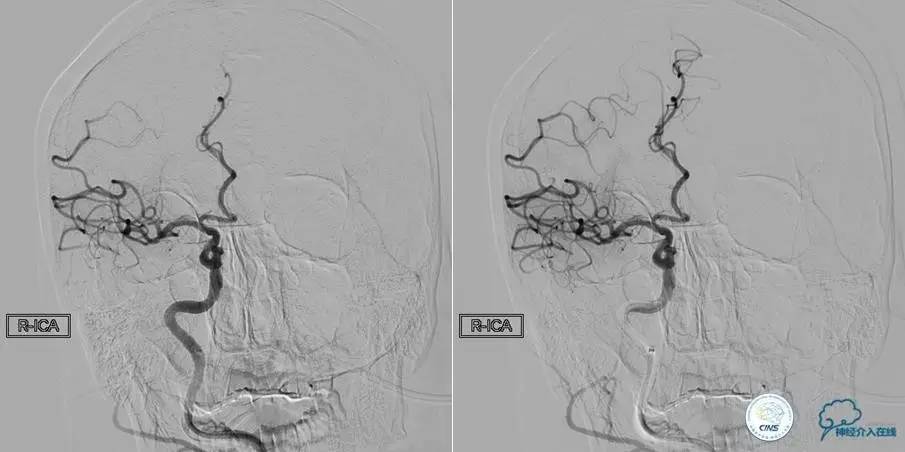 急性缺血性卒中静脉溶栓2018指南,急性缺血性卒中血管内再通标准