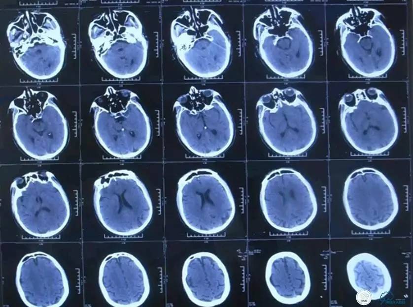 急性缺血性卒中静脉溶栓2018指南,急性缺血性卒中血管内再通标准