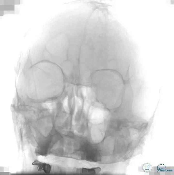 急性缺血性卒中静脉溶栓2018指南,急性缺血性卒中血管内再通标准