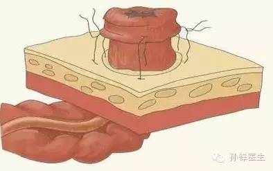 精品原创︱医生，您为什么要让我“挂粪袋”？