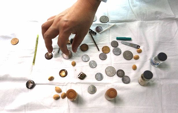 小孩误吞五毛硬币后续,5岁小孩误吞1元硬币到小肠