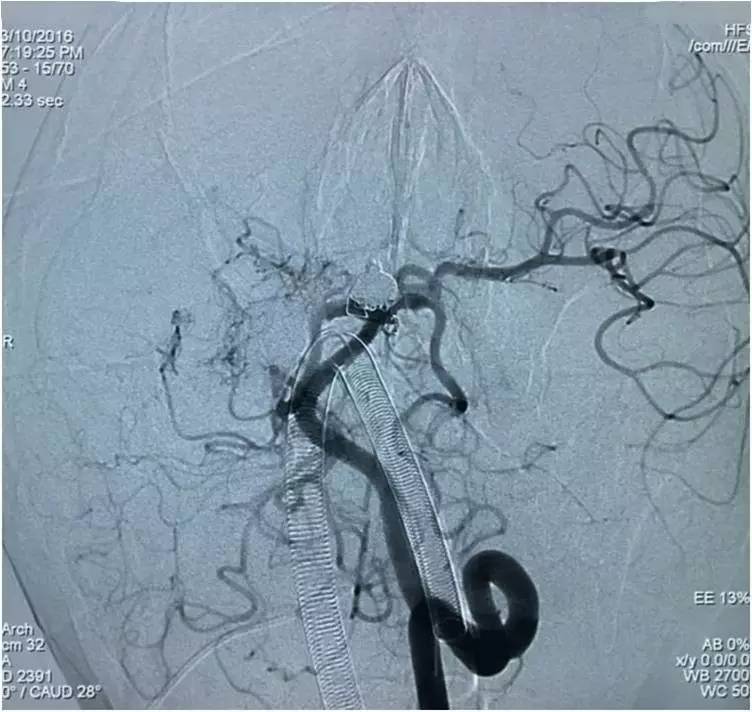 基底动脉顶端动脉瘤加左侧小脑上动脉瘤以Y型支架结合弹簧圈栓塞