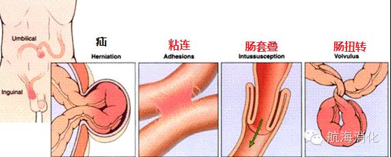 肠梗阻需要解决疑难护理问题,肠梗阻是大肠还是小肠问题