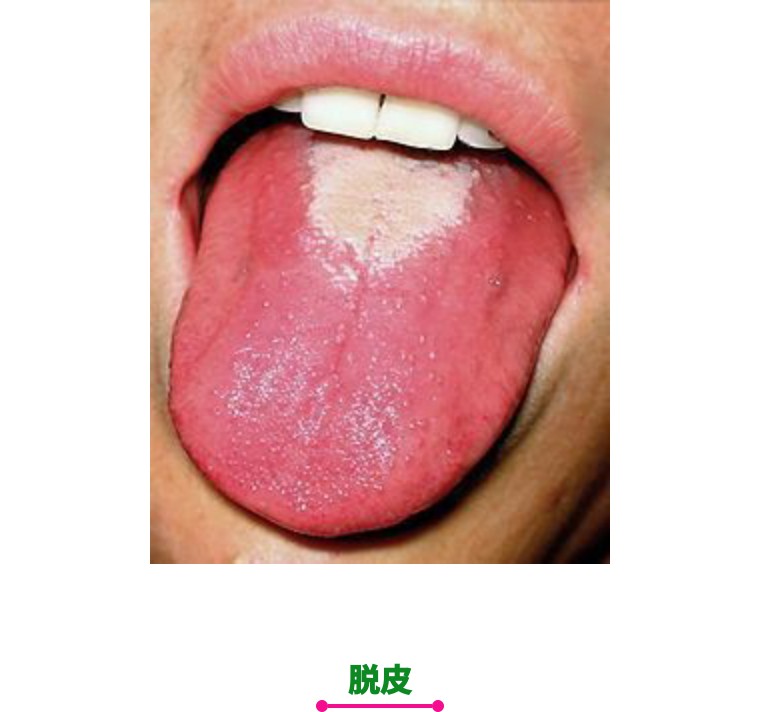 猩红热颜色,猩红热又开始了吗