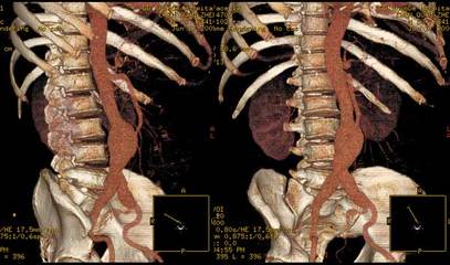 腹主动脉瘤的中医诊断,腹主动脉瘤手术费用是多少