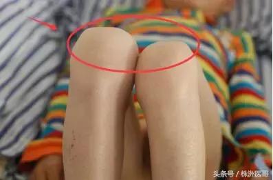 髋关节发育不良的孩子矫正视频,30岁发现先天性髋关节发育不良