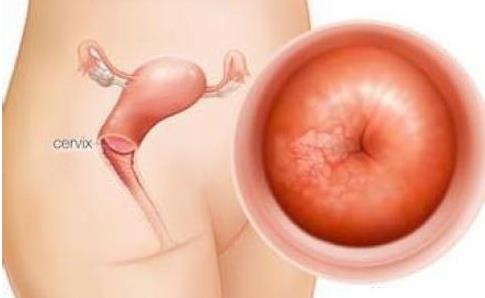宫颈炎高度病变怎么办,宫颈炎高级别病变有什么症状