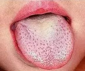 猩红热最新疫情报告发布,猩红热儿童预防