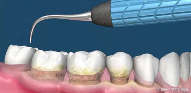 第一次洗牙后牙缝太大了怎么办,为什么洗牙后牙缝越来越大