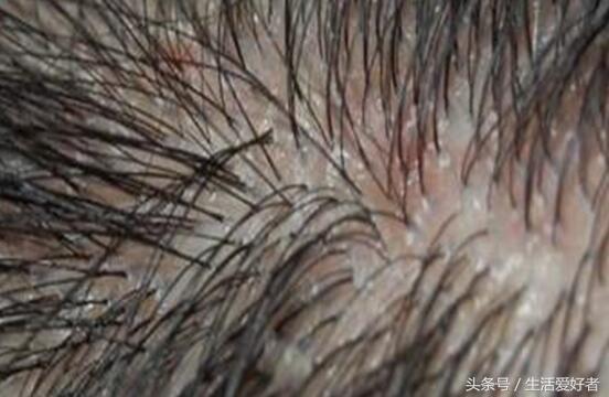 脂溢性脱发最新突破,脂溢性脱发最新研究成果
