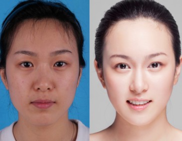 做自体脂肪丰唇多少钱,做自体脂肪填充泪沟多少钱