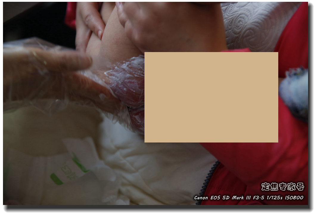 皮肤专家诊室故事连载之五,手心和眉心“开天眼”?