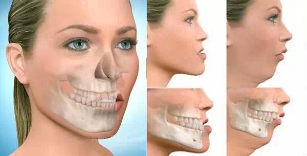 正颌手术后下颌后缩严重,医生下颚线真的可以锻炼出来吗