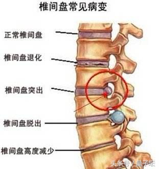 腰椎间盘突出放射到脚,放射科可以检查腰椎间盘突出吗