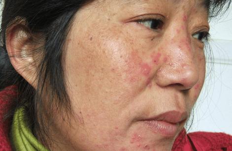 激素脸干燥用什么保湿,激素脸皮肤干燥用什么好